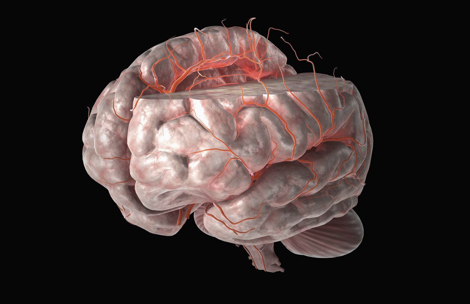 25-facts-about-middle-cerebral-artery-syndrome