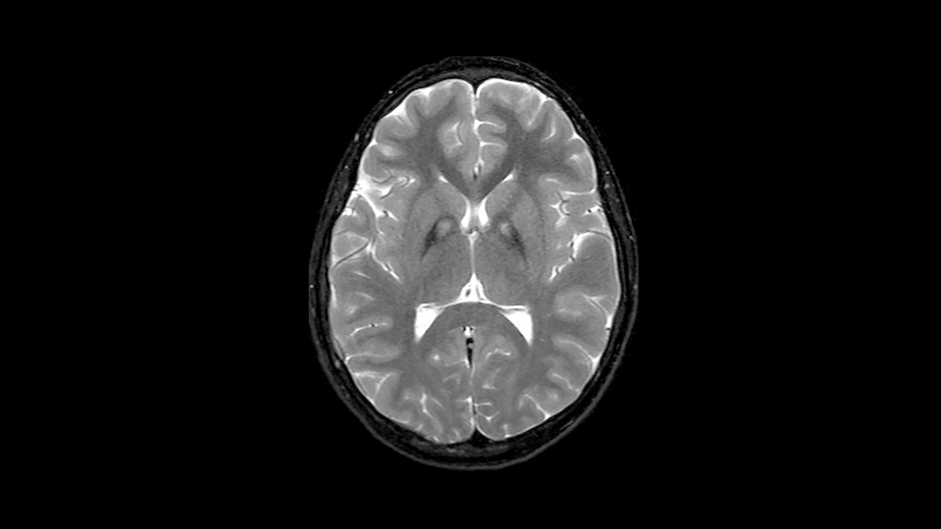 25-facts-about-pantothenate-kinase-associated-neurodegeneration