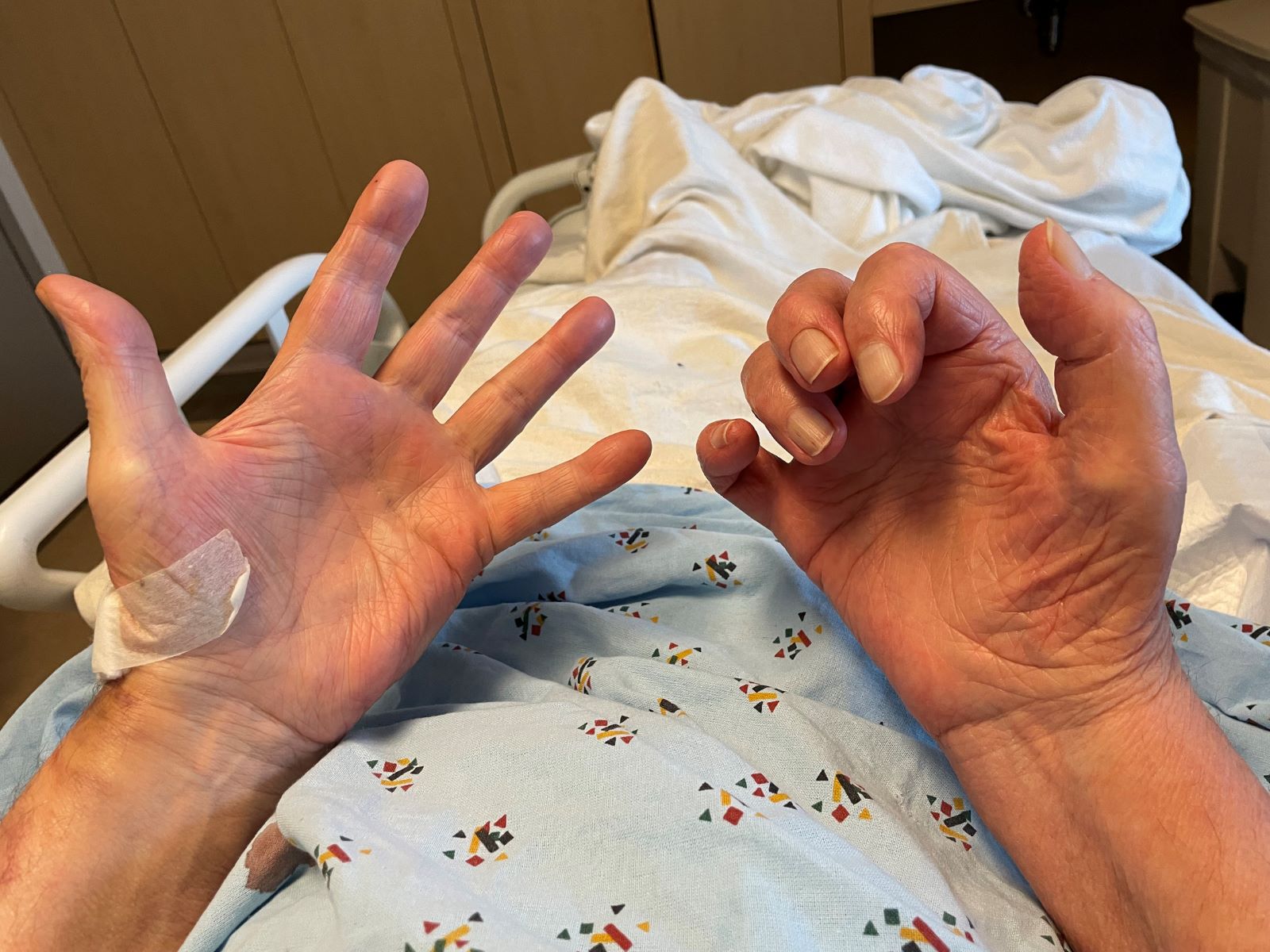 30-facts-about-cerebral-malformations-hypertrichosis-claw-hands