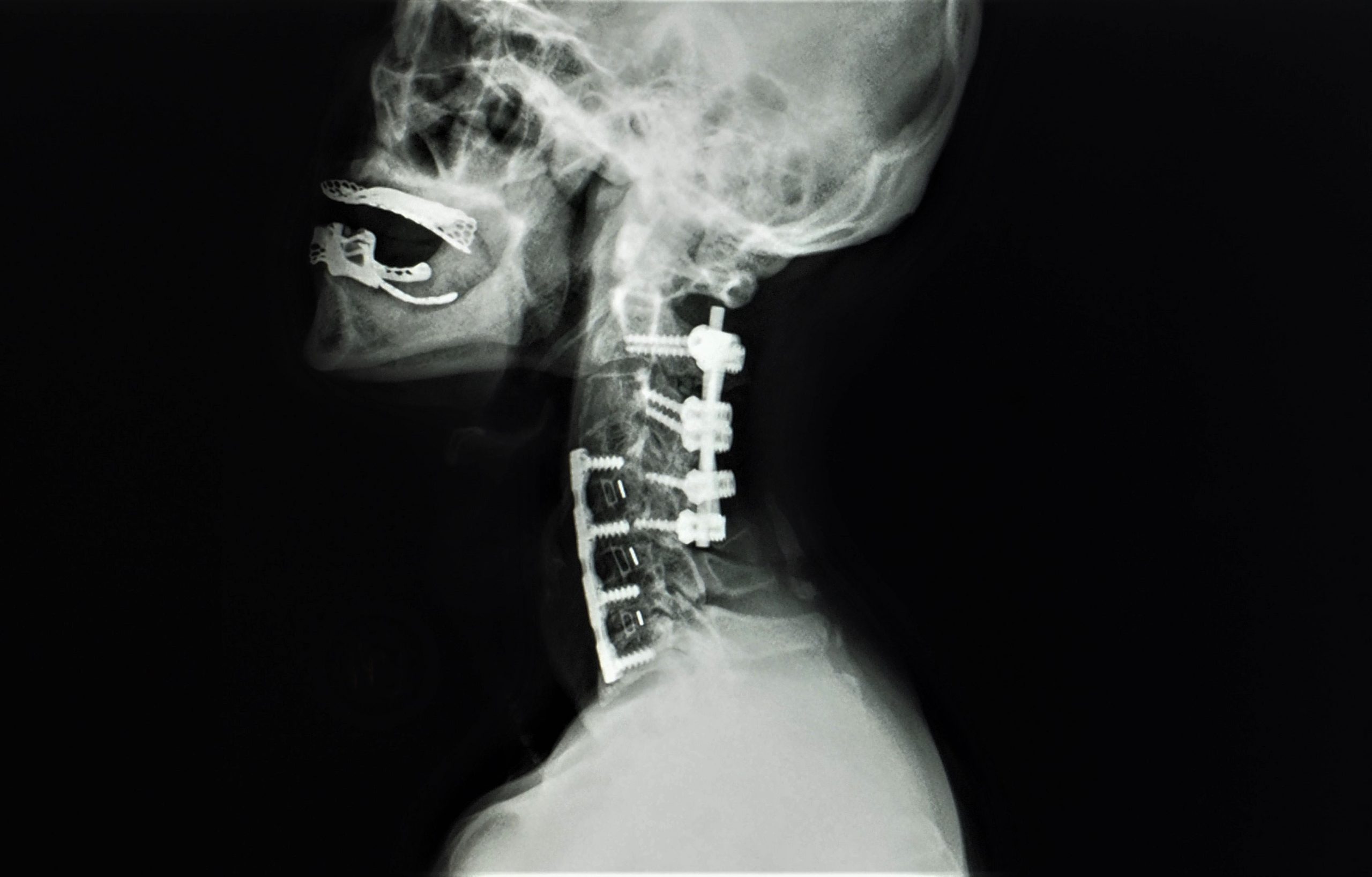 30-facts-about-cervical-vertebral-fusion