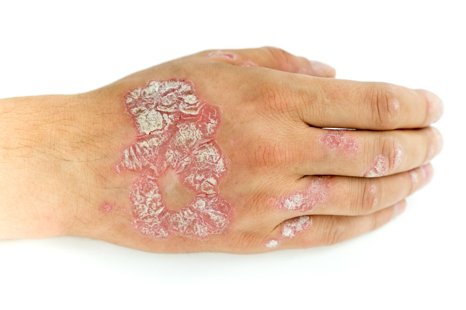 30-facts-about-childhood-pustular-psoriasis