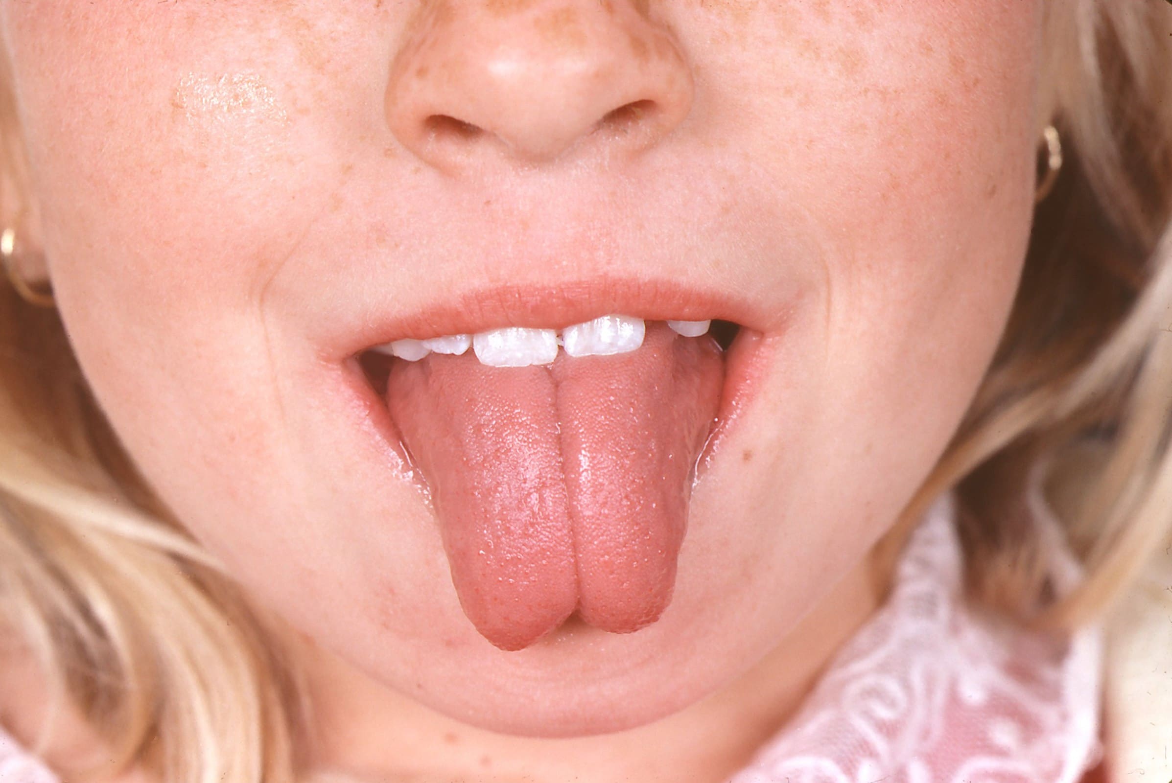 30-facts-about-cleft-tongue