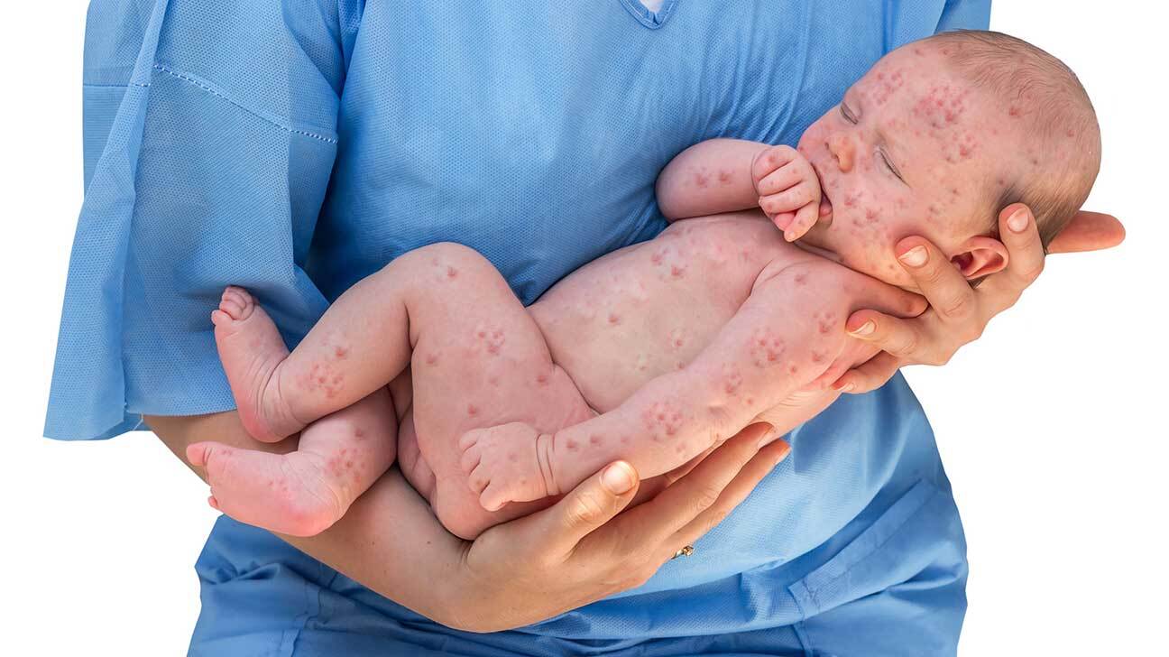 30-facts-about-congenital-herpes-simplex