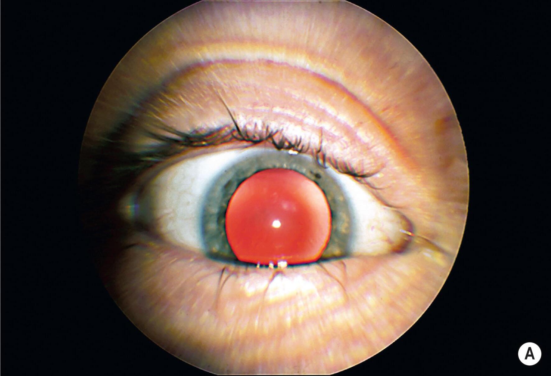 30-facts-about-corneal-anesthesia-deafness-mental-retardation