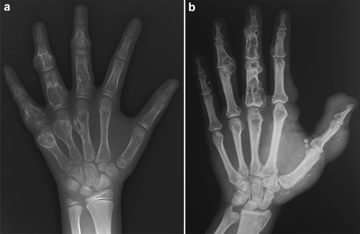 30-facts-about-cranio-osteoarthropathy