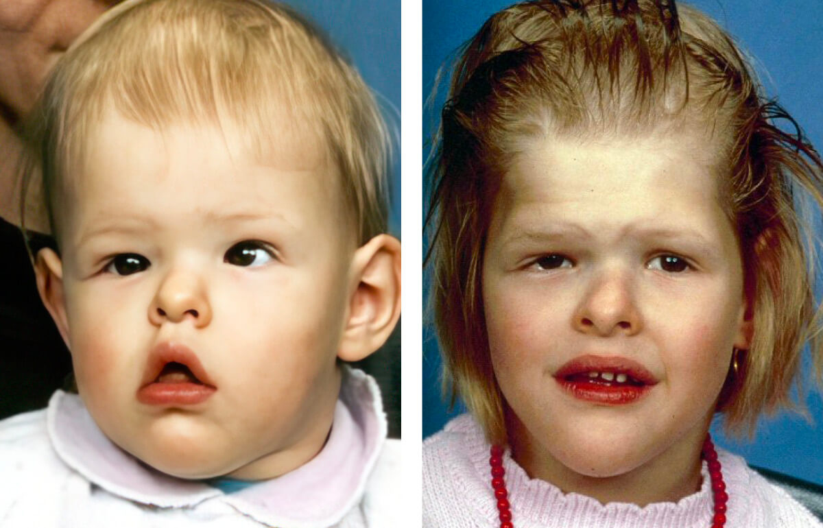 30-facts-about-craniofacial-and-osseous-defects-mental-retardation