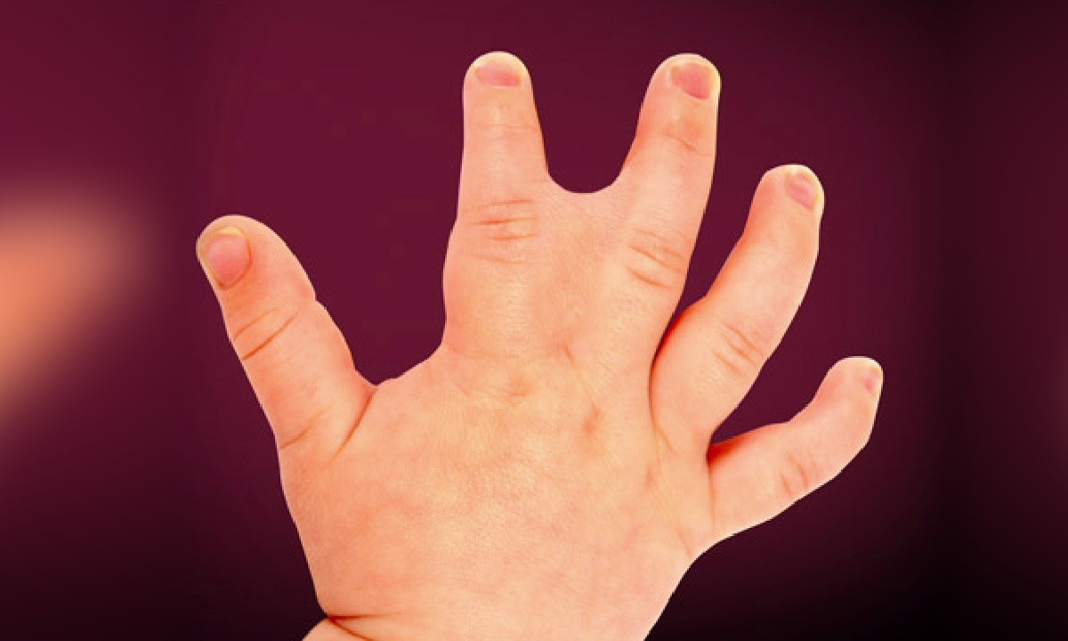 30-facts-about-craniofacial-deafness-hand