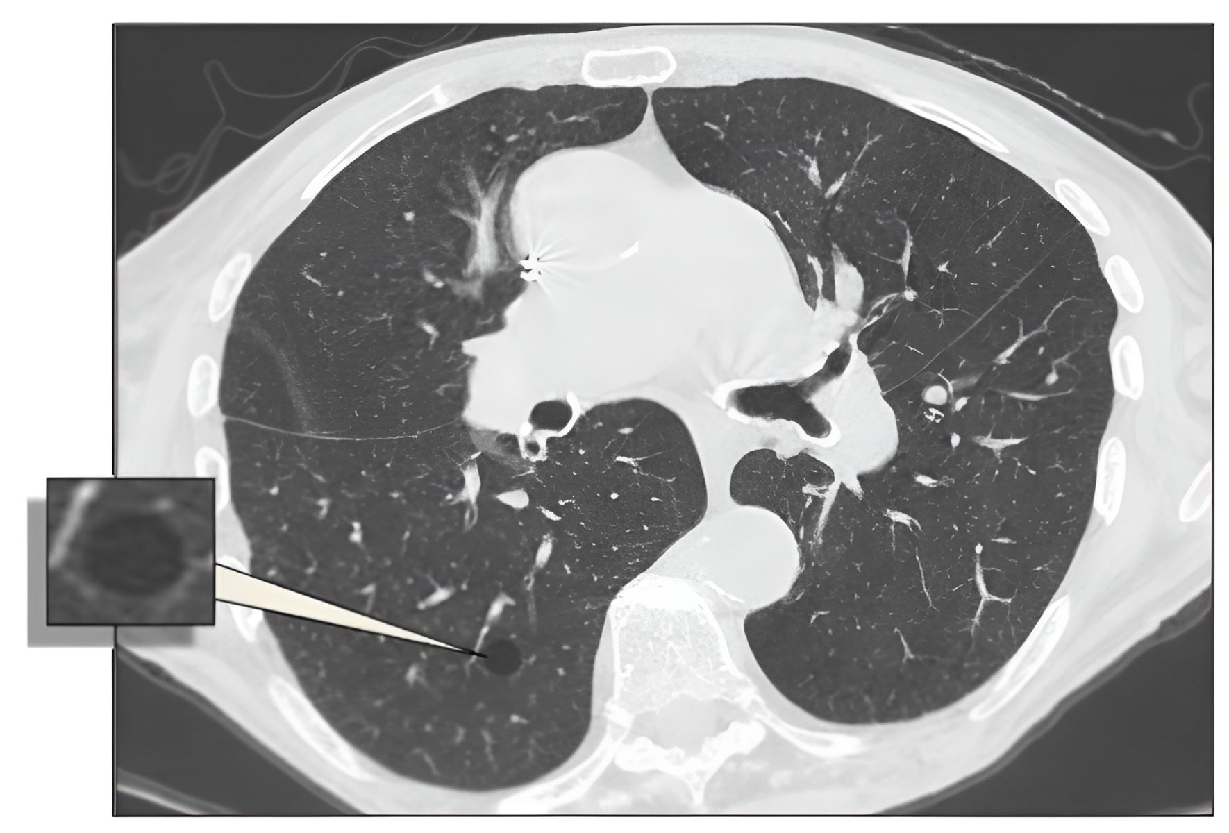 30-facts-about-cystic-hamartoma-of-lung-and-kidney