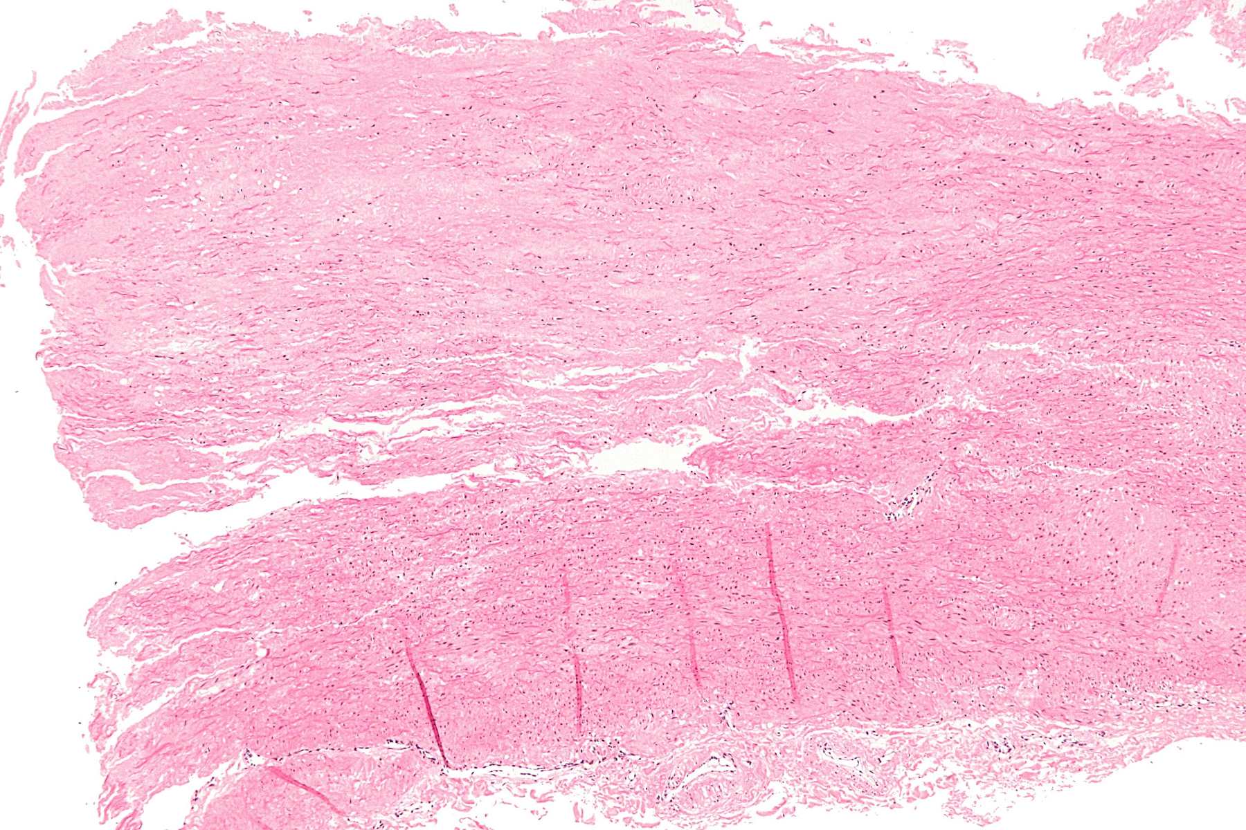 30-facts-about-cystic-medial-necrosis-of-aorta