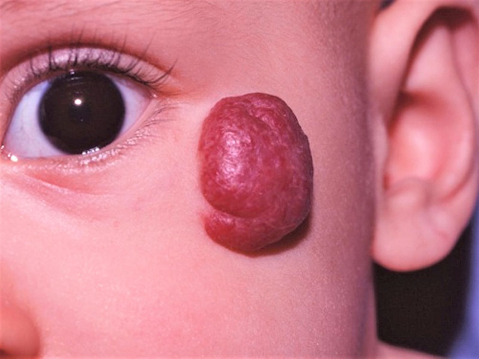 30-facts-about-dandy-walker-facial-hemangioma