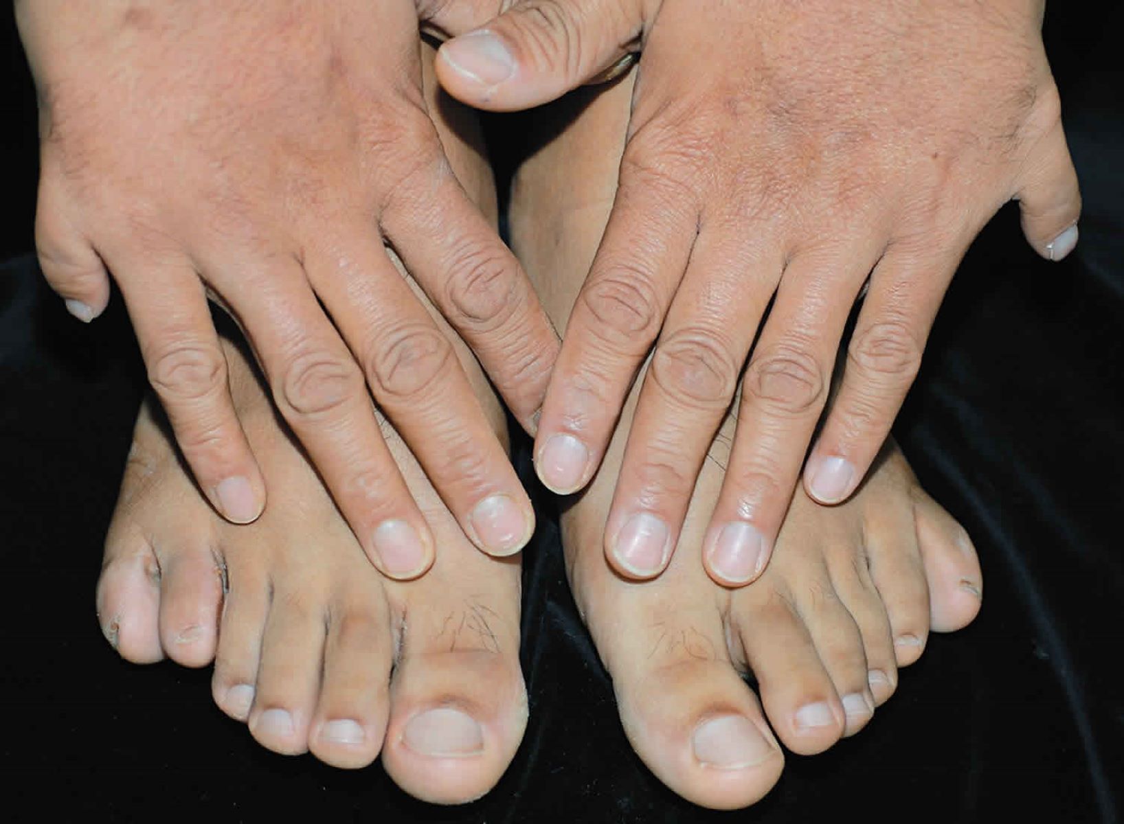 30-facts-about-dandy-walker-malformation-postaxial-polydactyly