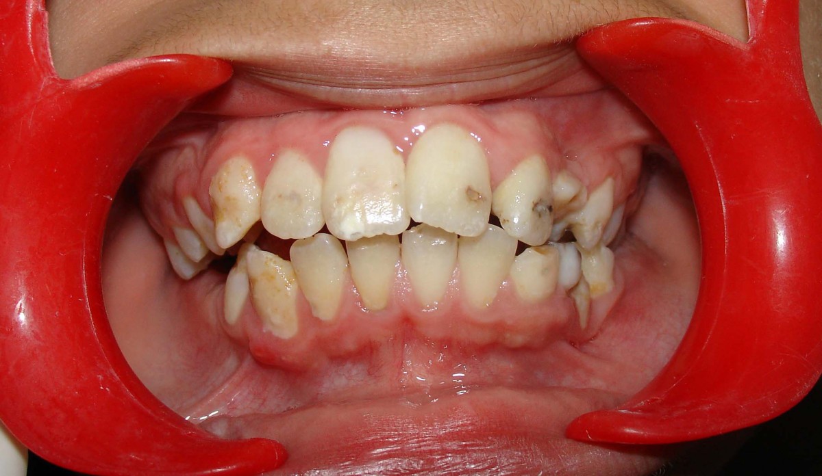 30-facts-about-dentin-dysplasia-sclerotic-bones