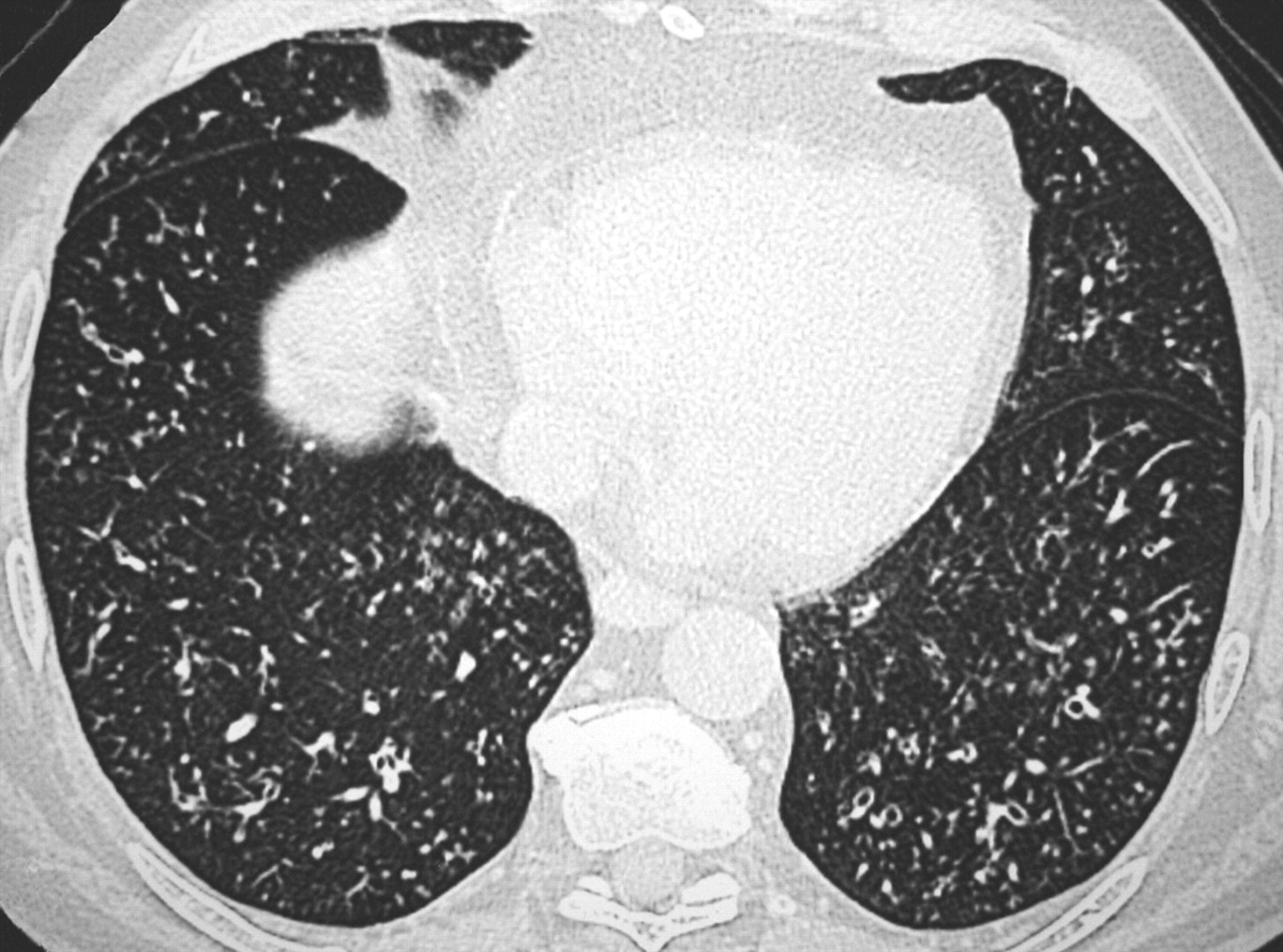 30-facts-about-diffuse-panbronchiolitis