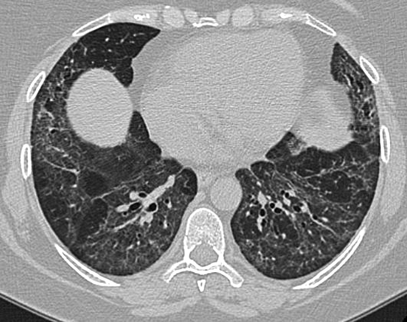 30-facts-about-diffuse-parenchymal-lung-disease