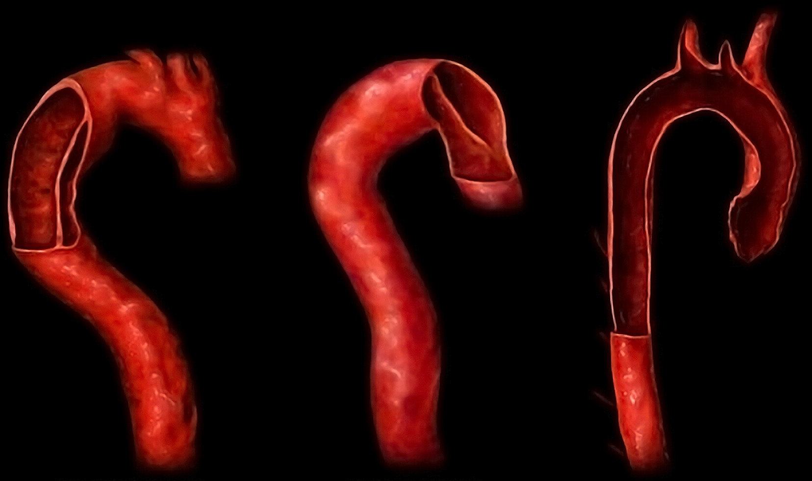 30-facts-about-familial-aortic-dissection