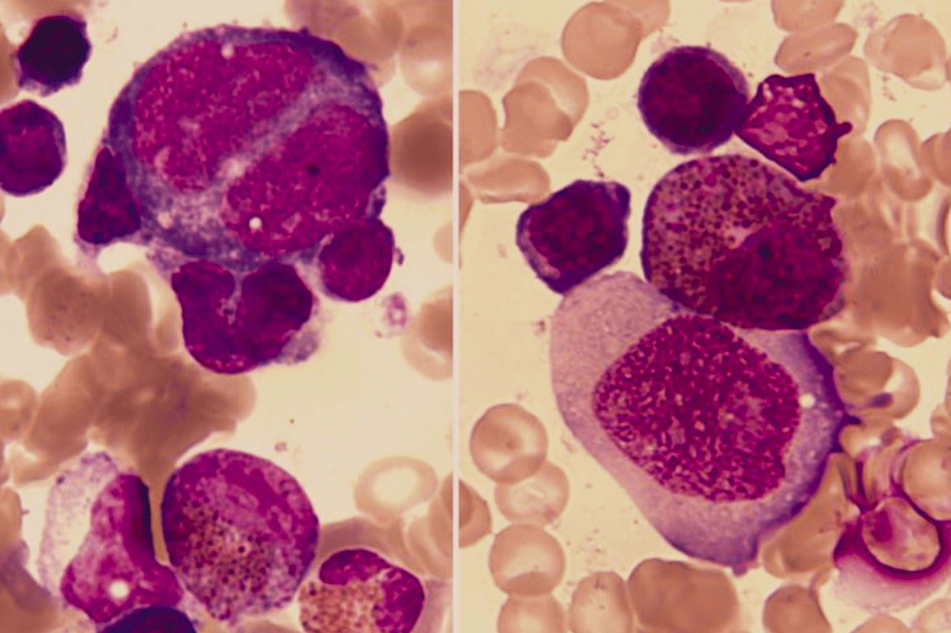 30-facts-about-familial-eosinophilia