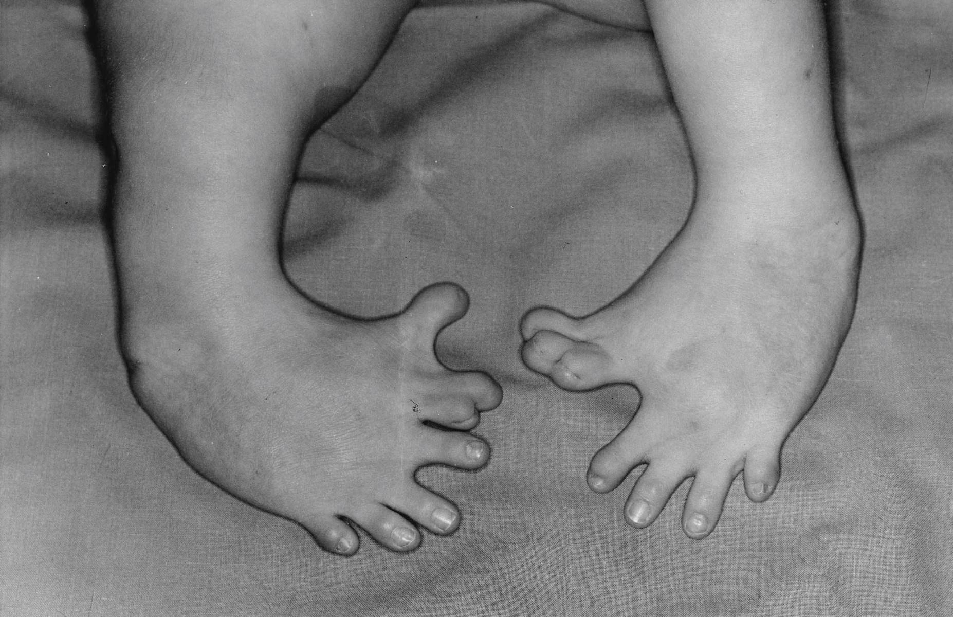 30-facts-about-fetal-thalidomide