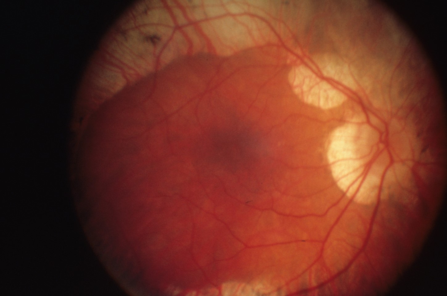 30-facts-about-gyrate-atrophy-of-the-retina