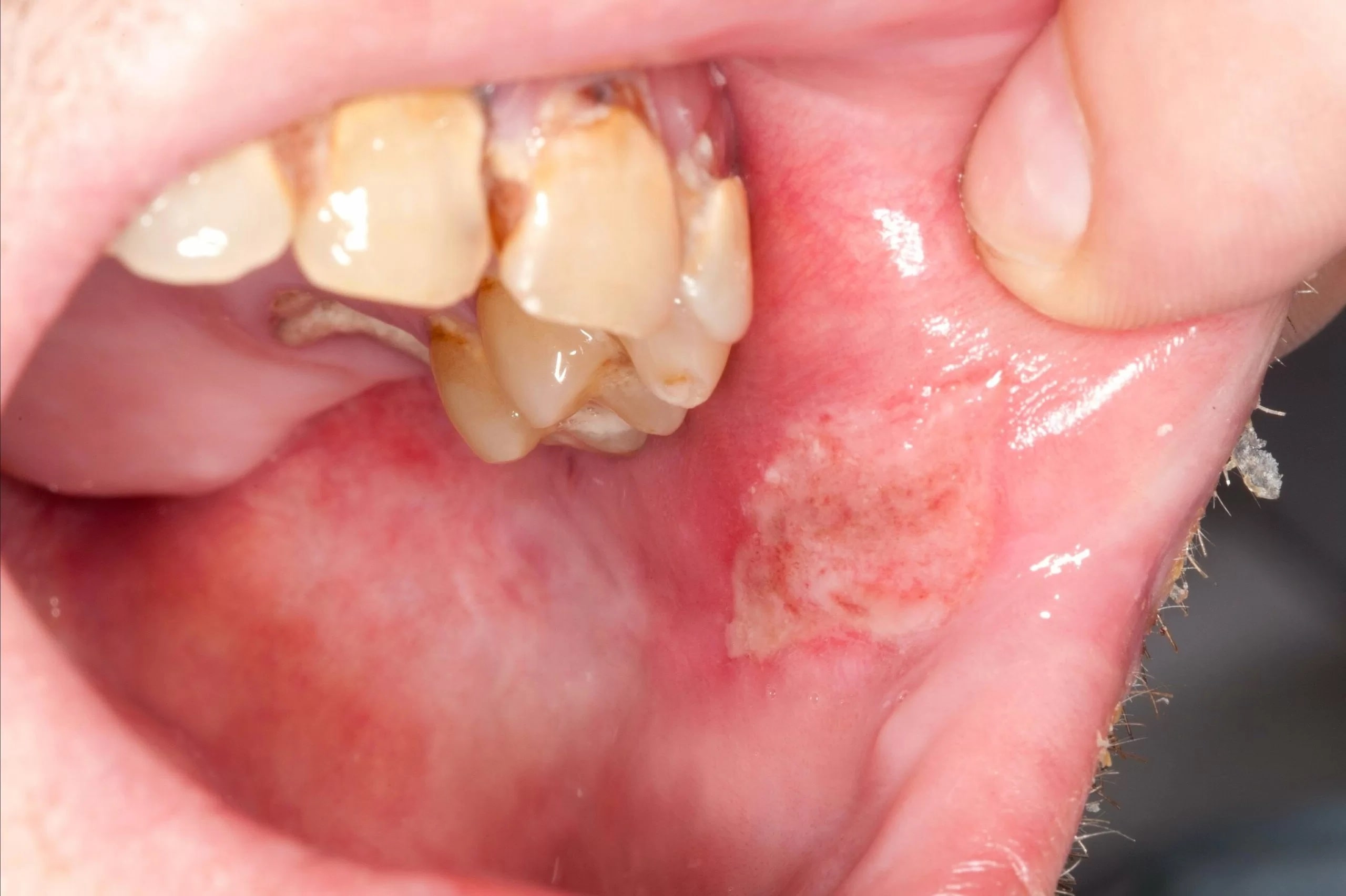 30-facts-about-mouth-and-genital-ulcers-with-inflamed-cartilage-syndrome