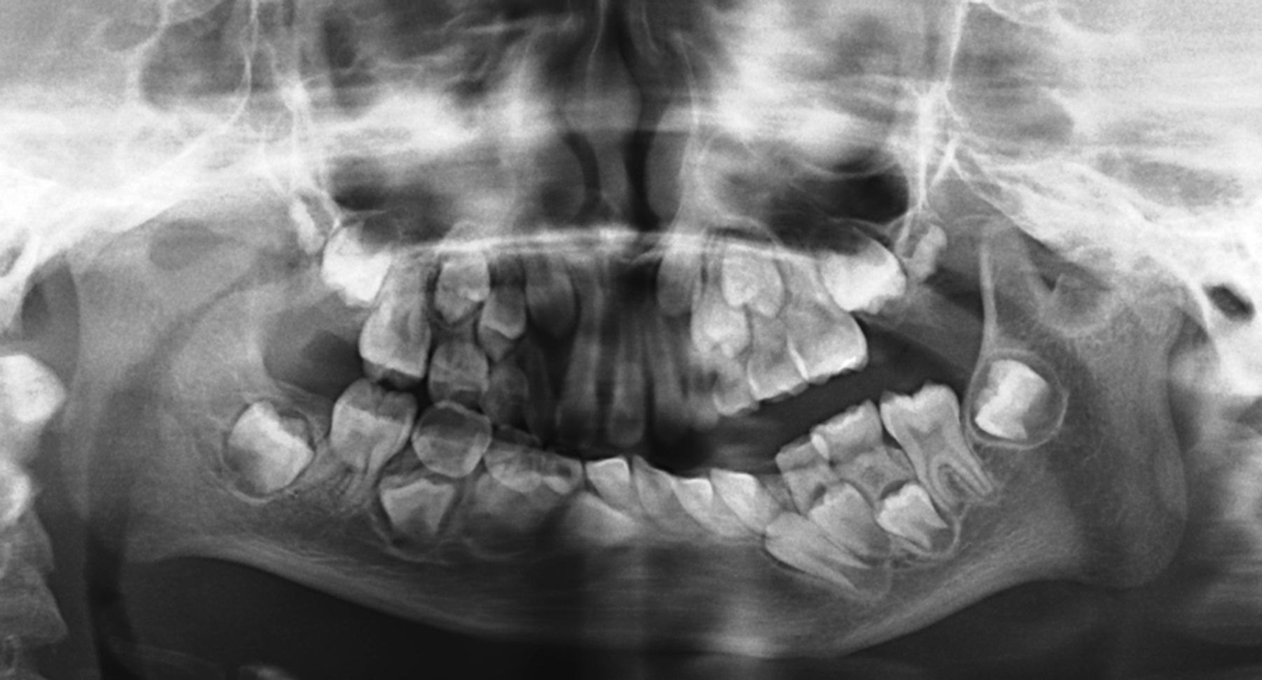 30-facts-about-nager-acrofacial-dysostosis