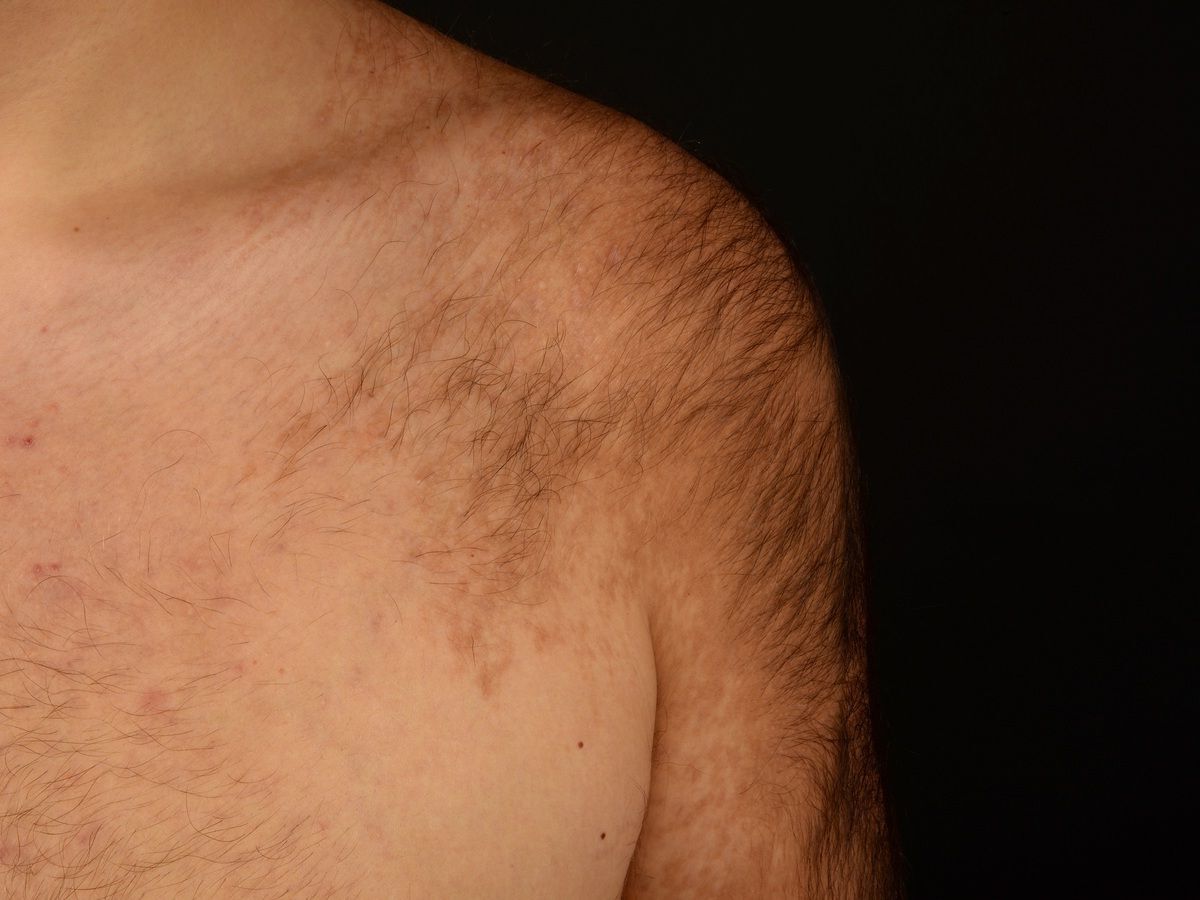 30-facts-about-pigmented-hairy-epidermal-nevus-syndrome