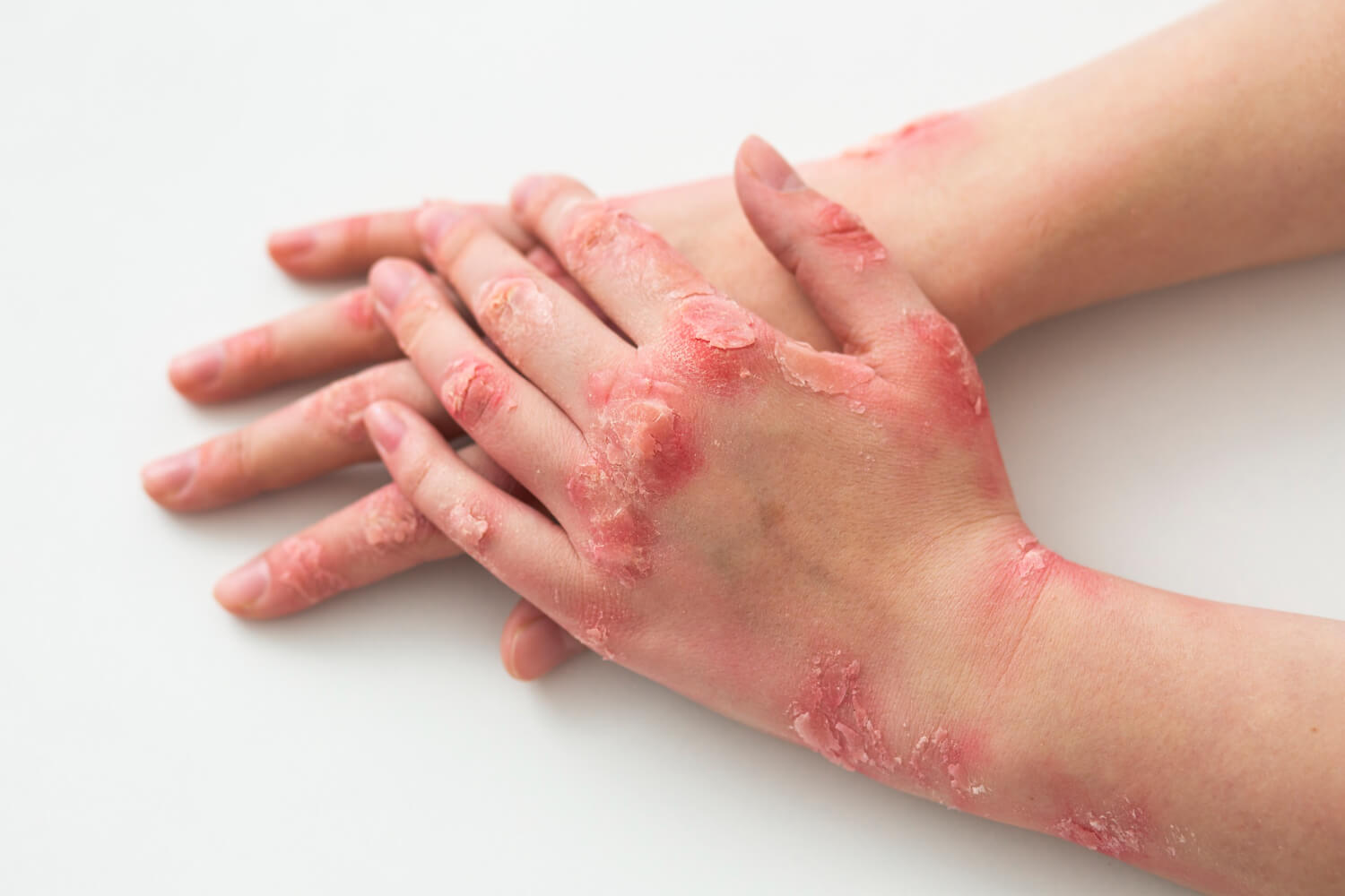 30-facts-about-skin-fragility-syndrome