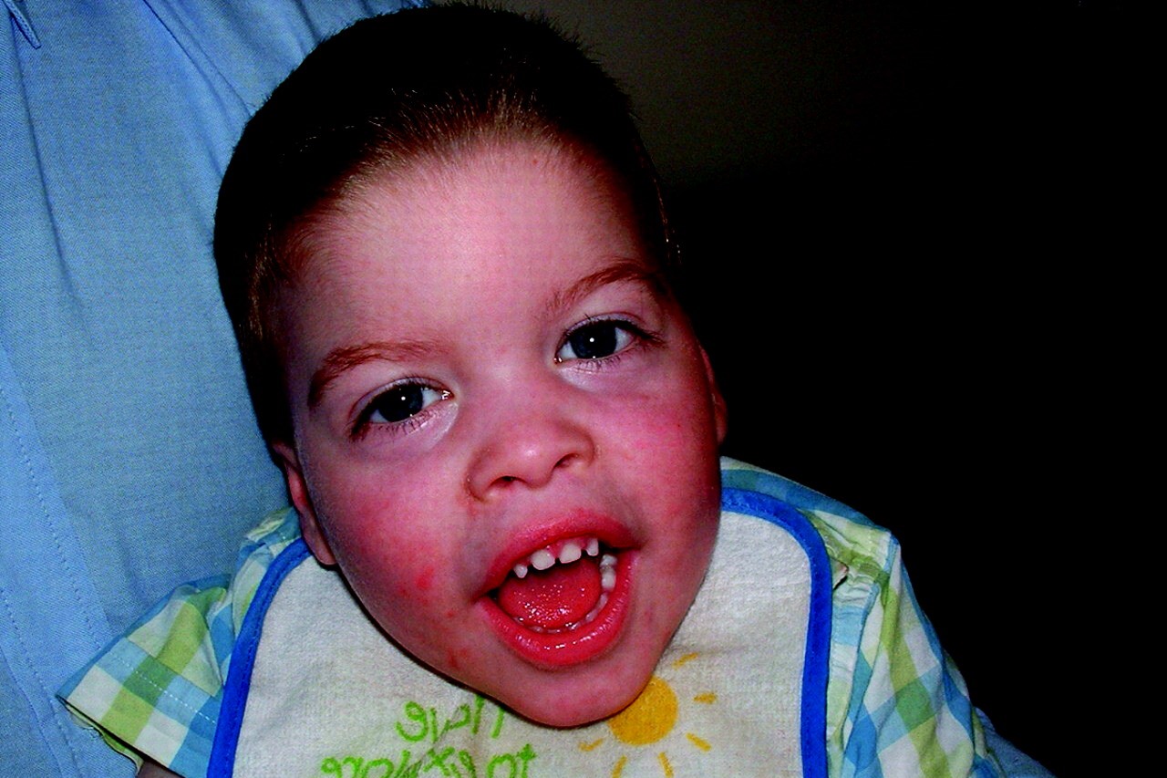 30-facts-about-smith-fineman-myers-syndrome