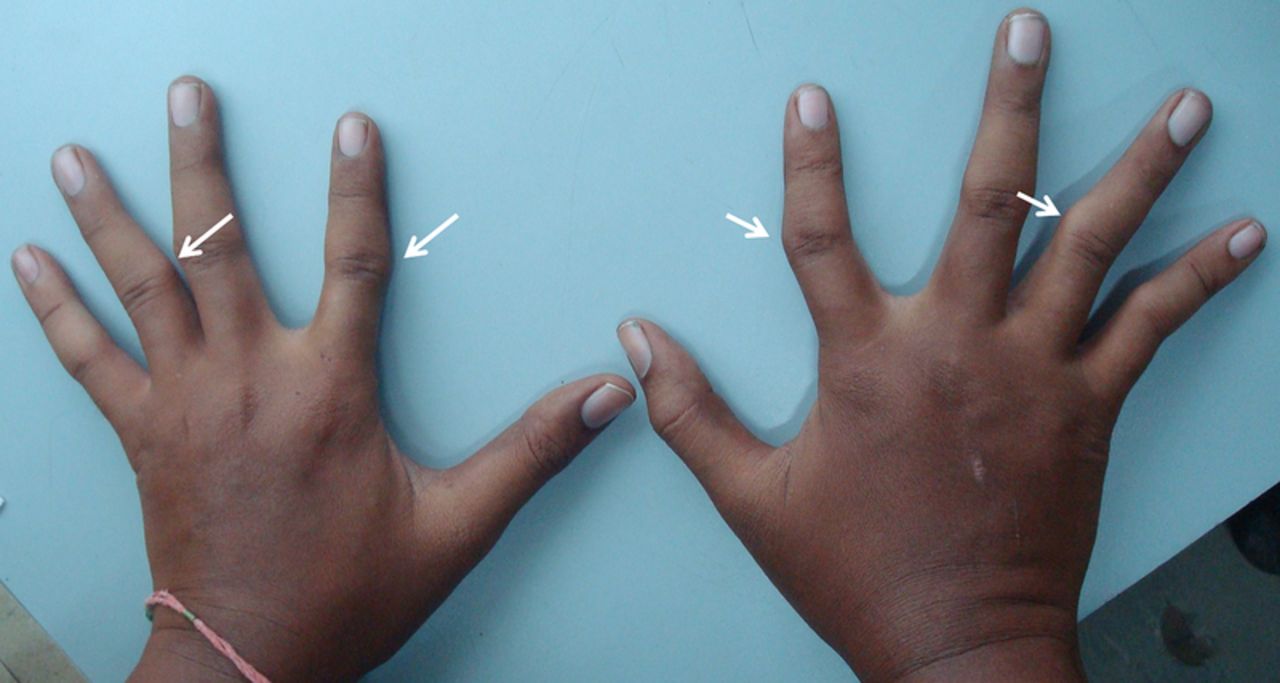 30-facts-about-tricho-rhino-phalangeal-syndrome