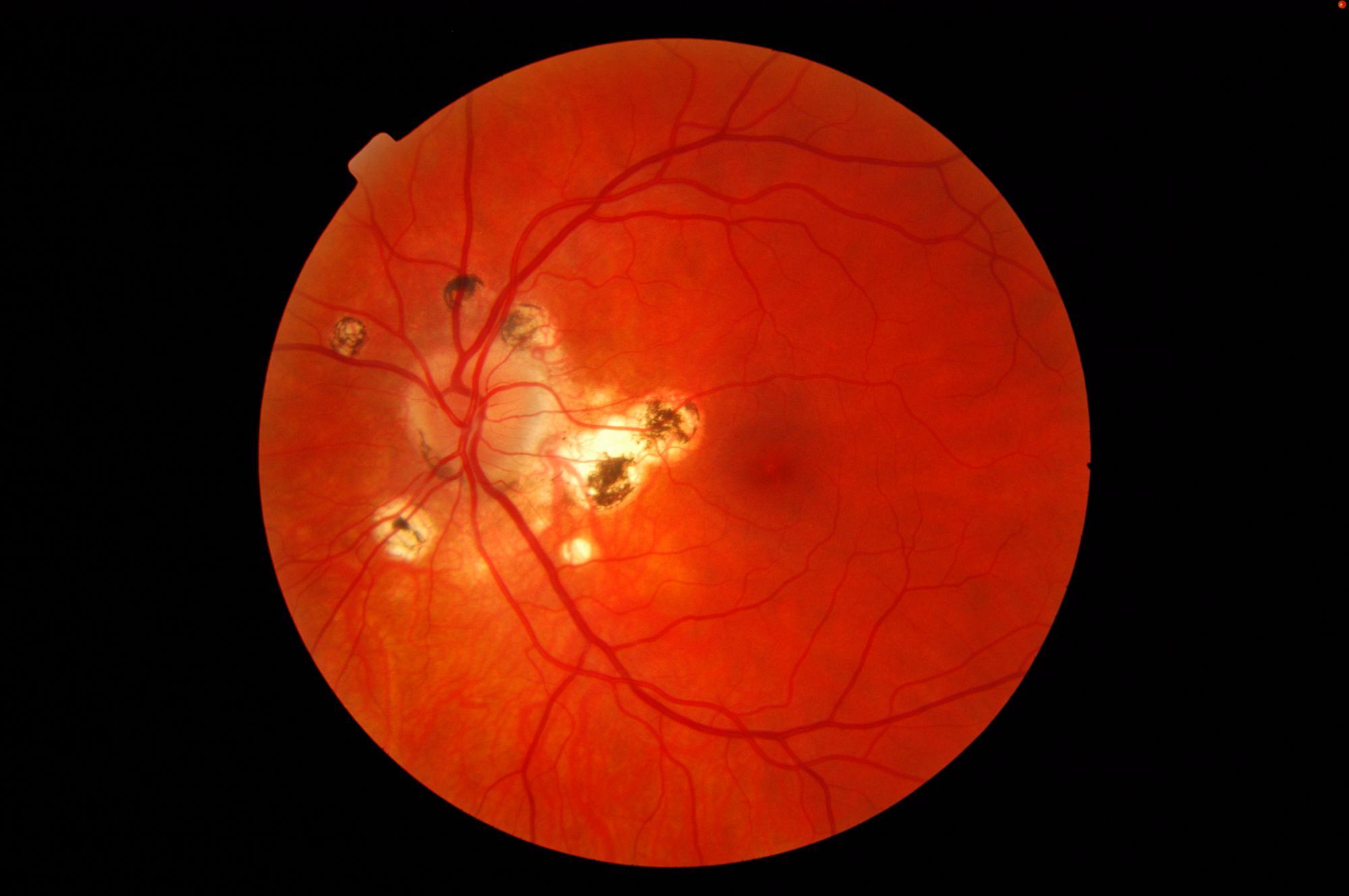 35-facts-about-presumed-ocular-histoplasmosis-syndrome