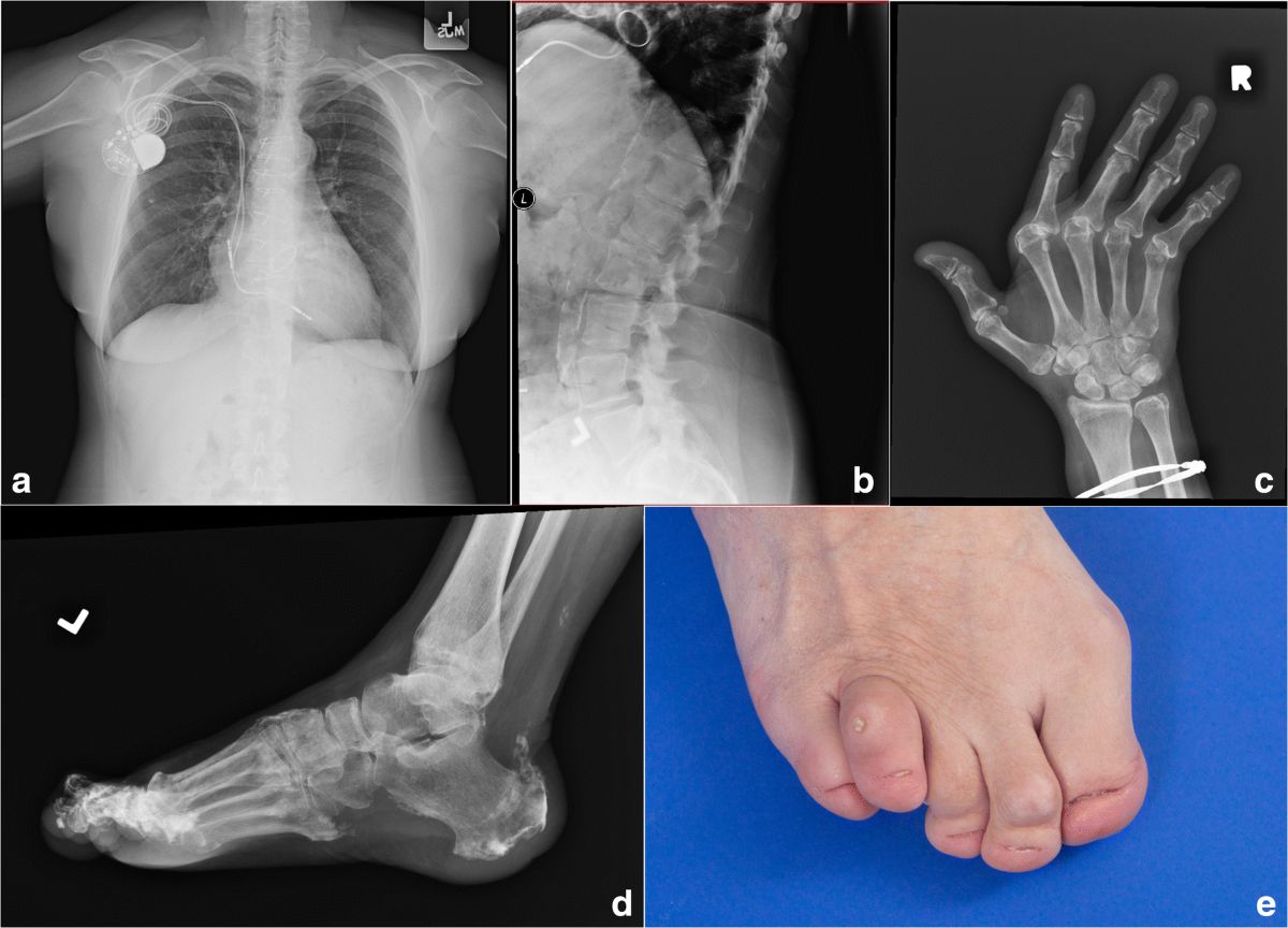 35-facts-about-singleton-merten-syndrome