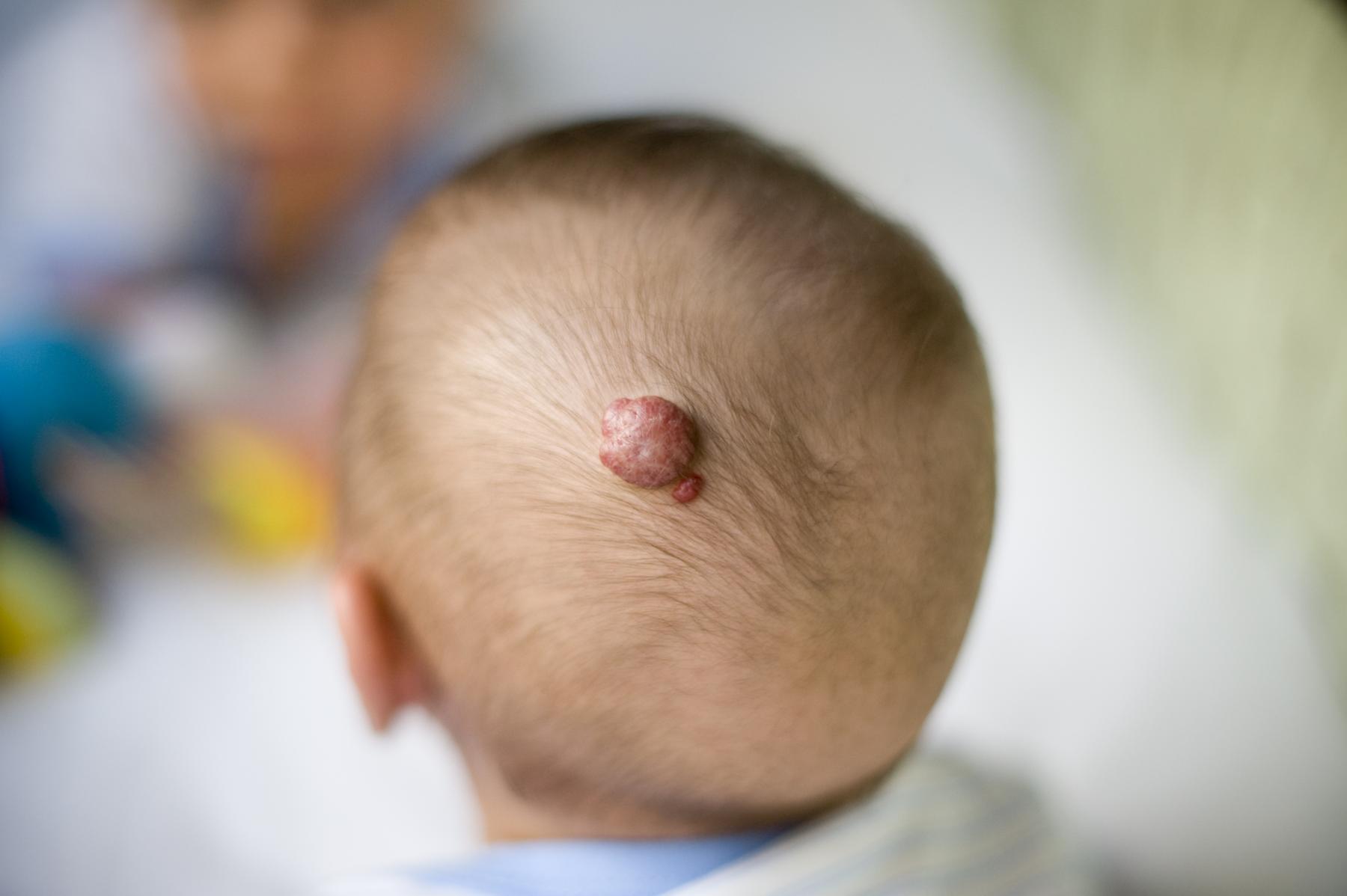 40-facts-about-cavernous-hemangioma