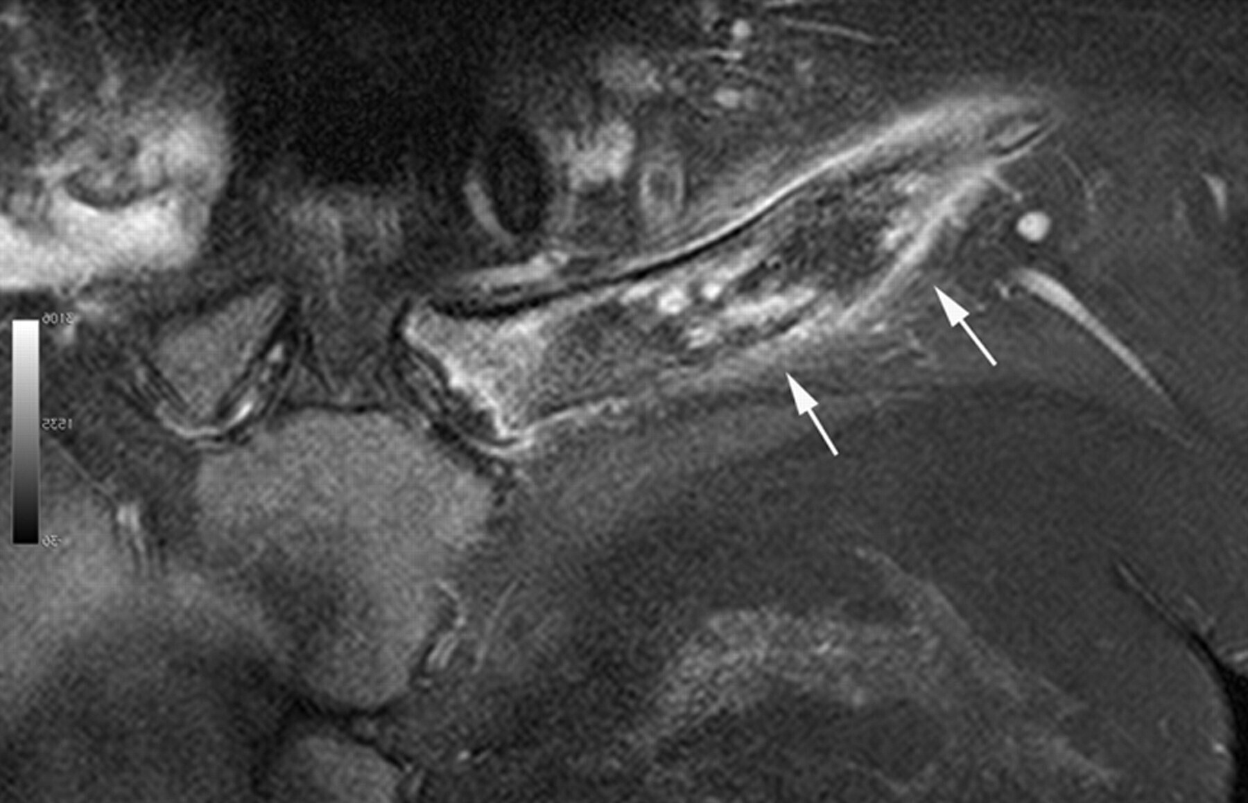 40-facts-about-chronic-recurrent-multifocal-osteomyelitis