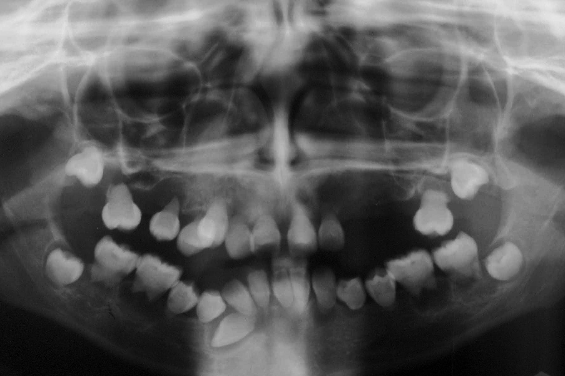 40-facts-about-dentin-dysplasia