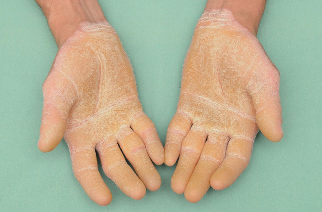 40-facts-about-diffuse-palmoplantar-keratoderma