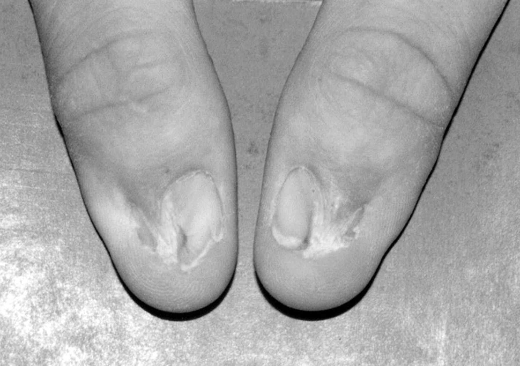 40-facts-about-nail-patella-syndrome