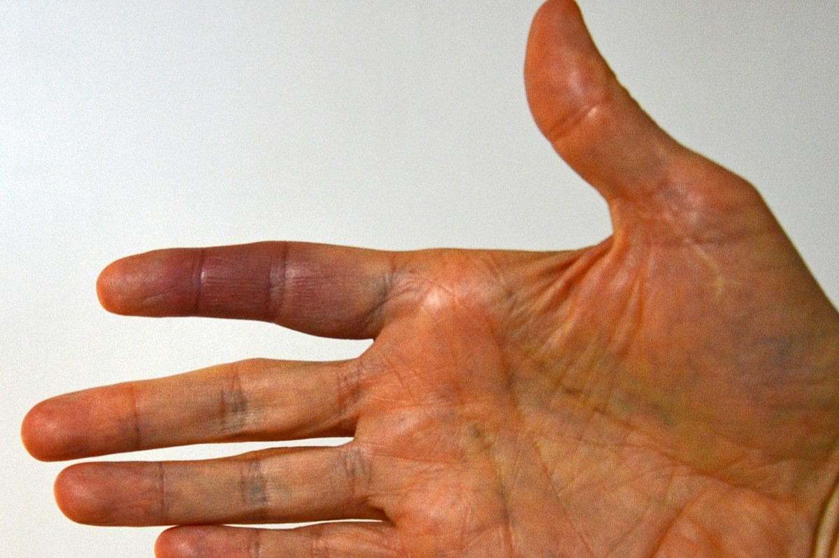 40-facts-about-paroxysmal-hand-hematoma