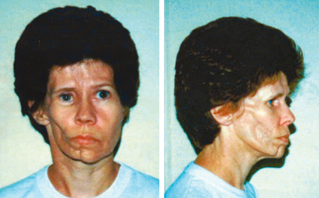 40-facts-about-parry-romberg-syndrome