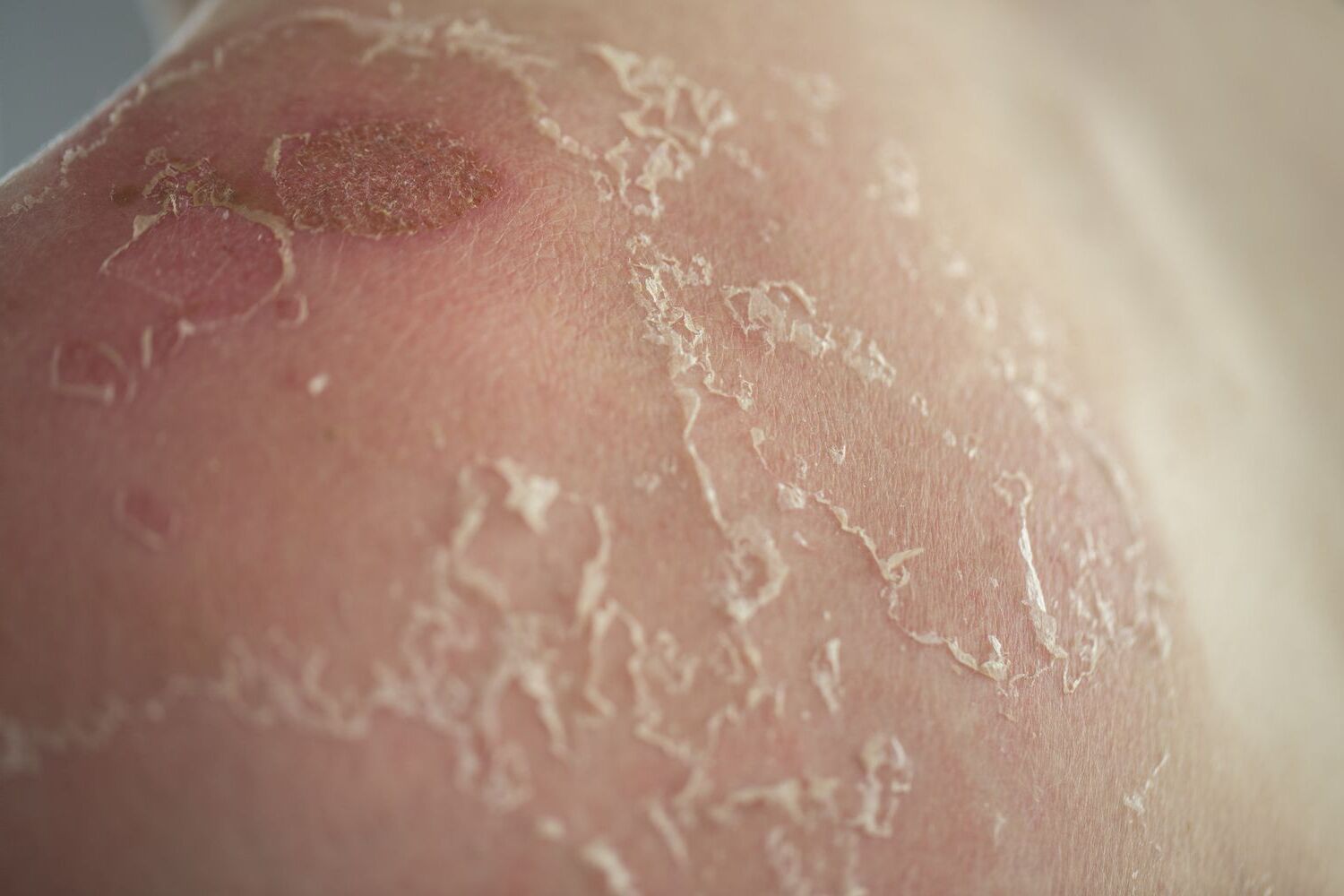 40 Facts About Peeling Skin Syndrome 