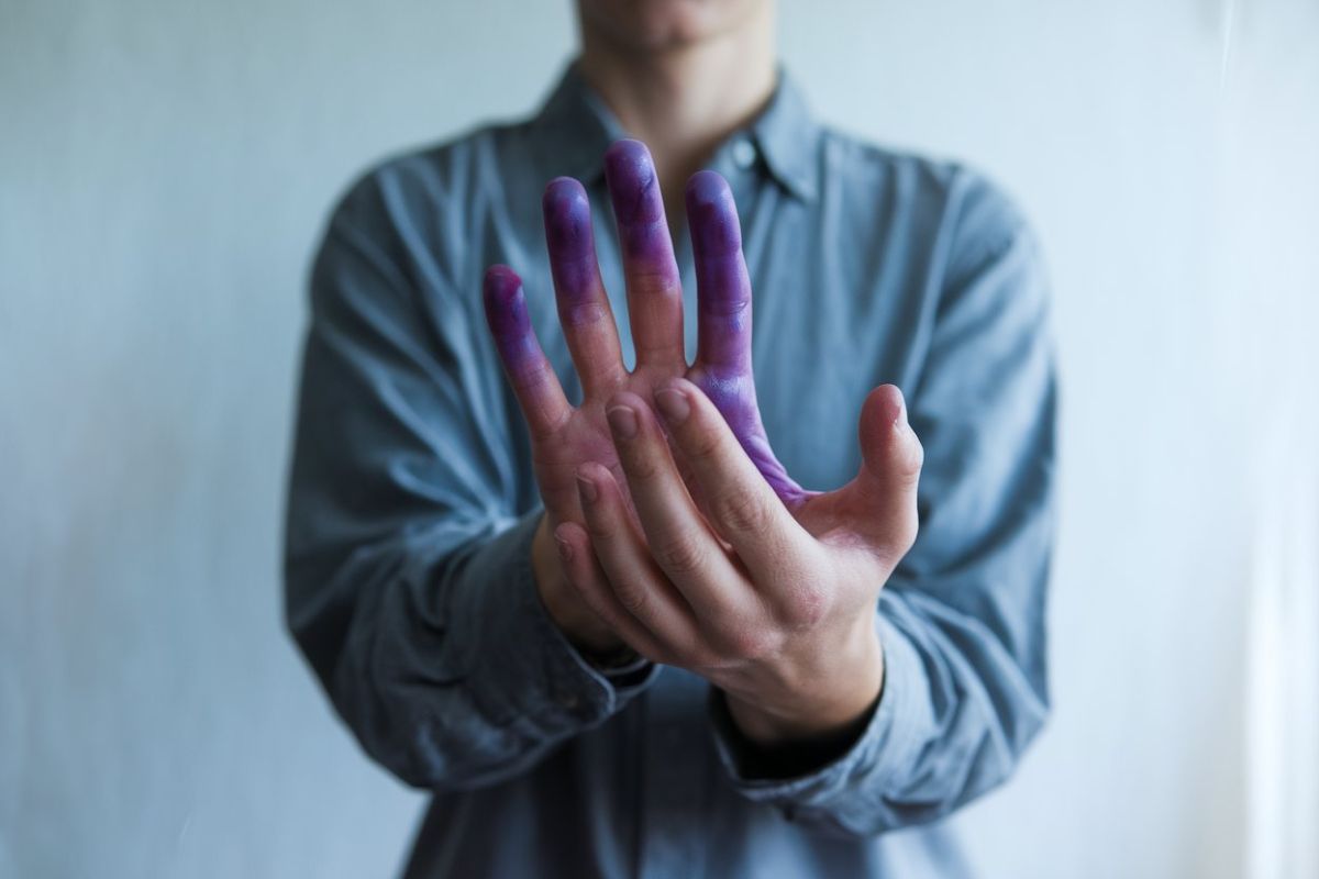 40-facts-about-purple-glove-syndrome