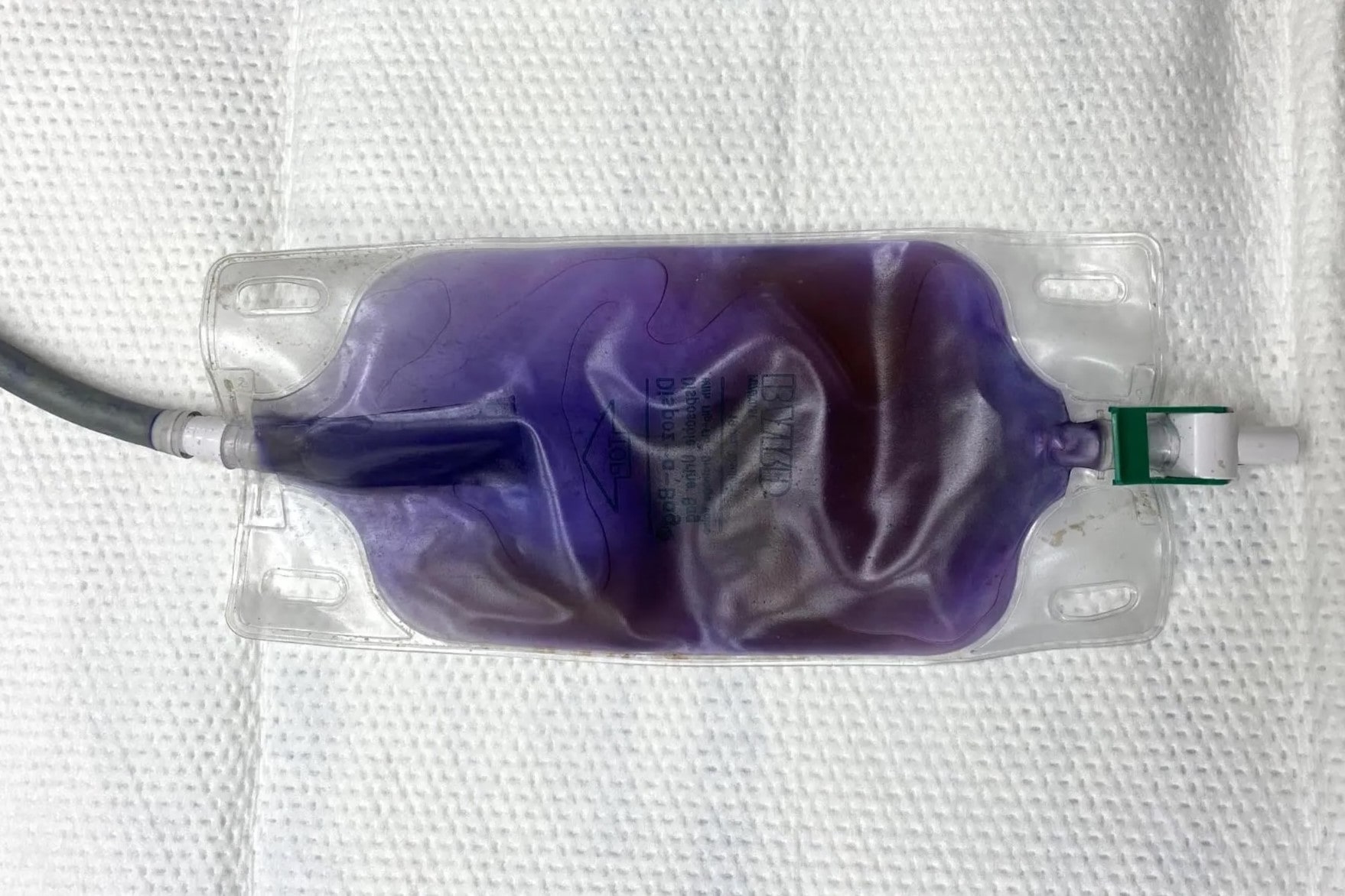 40-facts-about-purple-urine-bag-syndrome