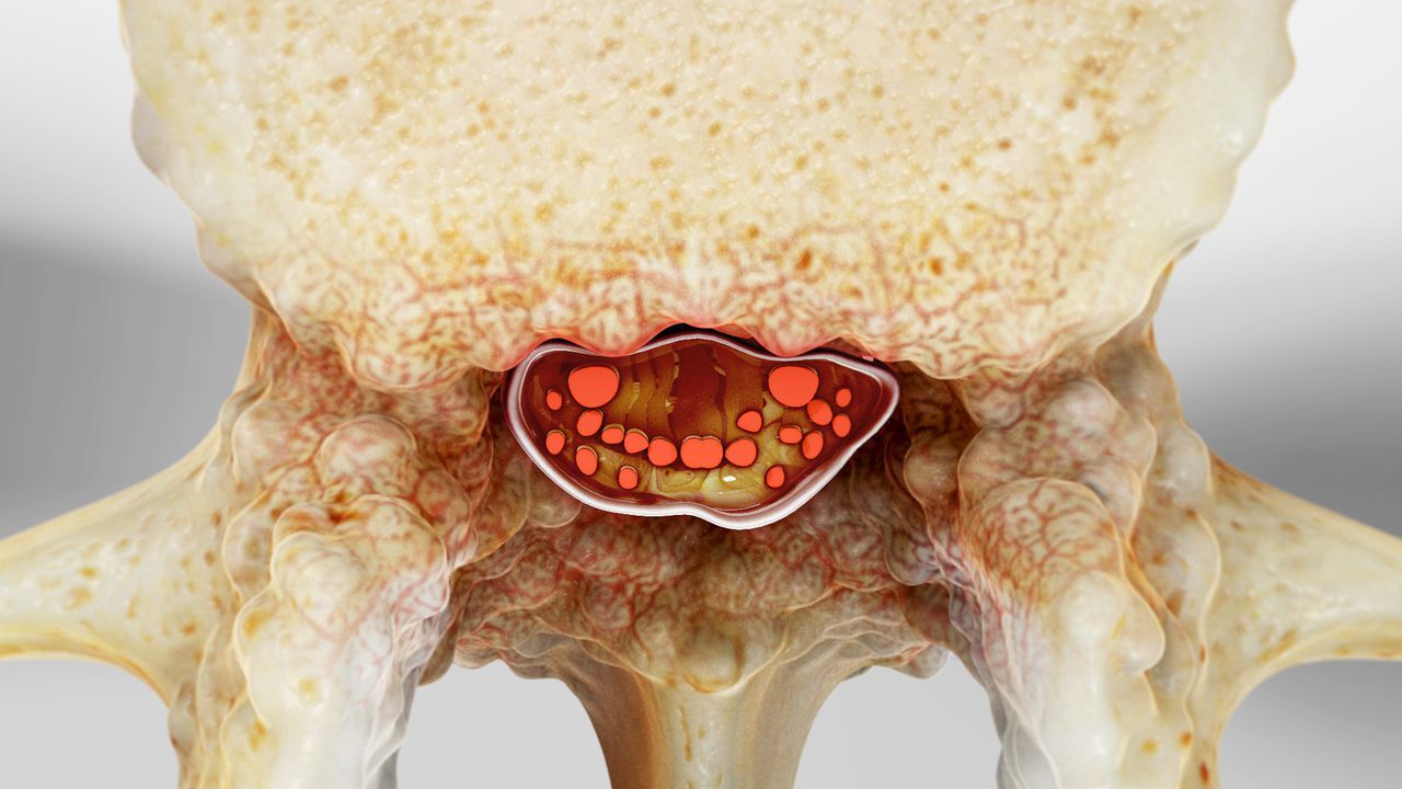 45-facts-about-cervical-spinal-stenosis