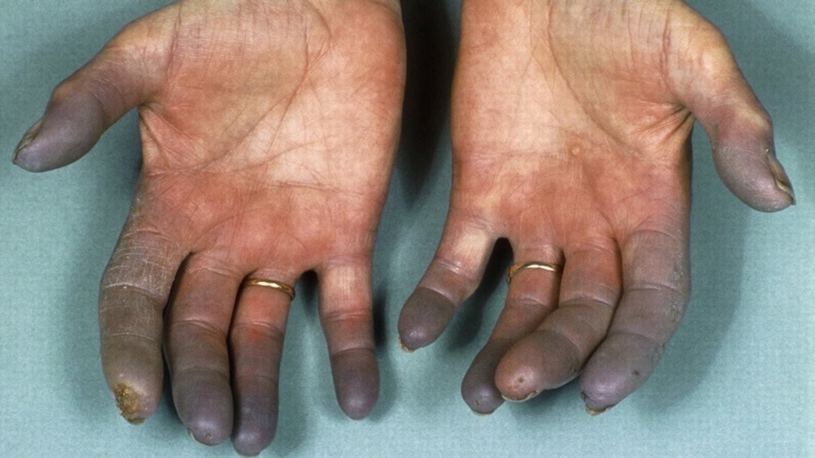 50-facts-about-buergers-disease