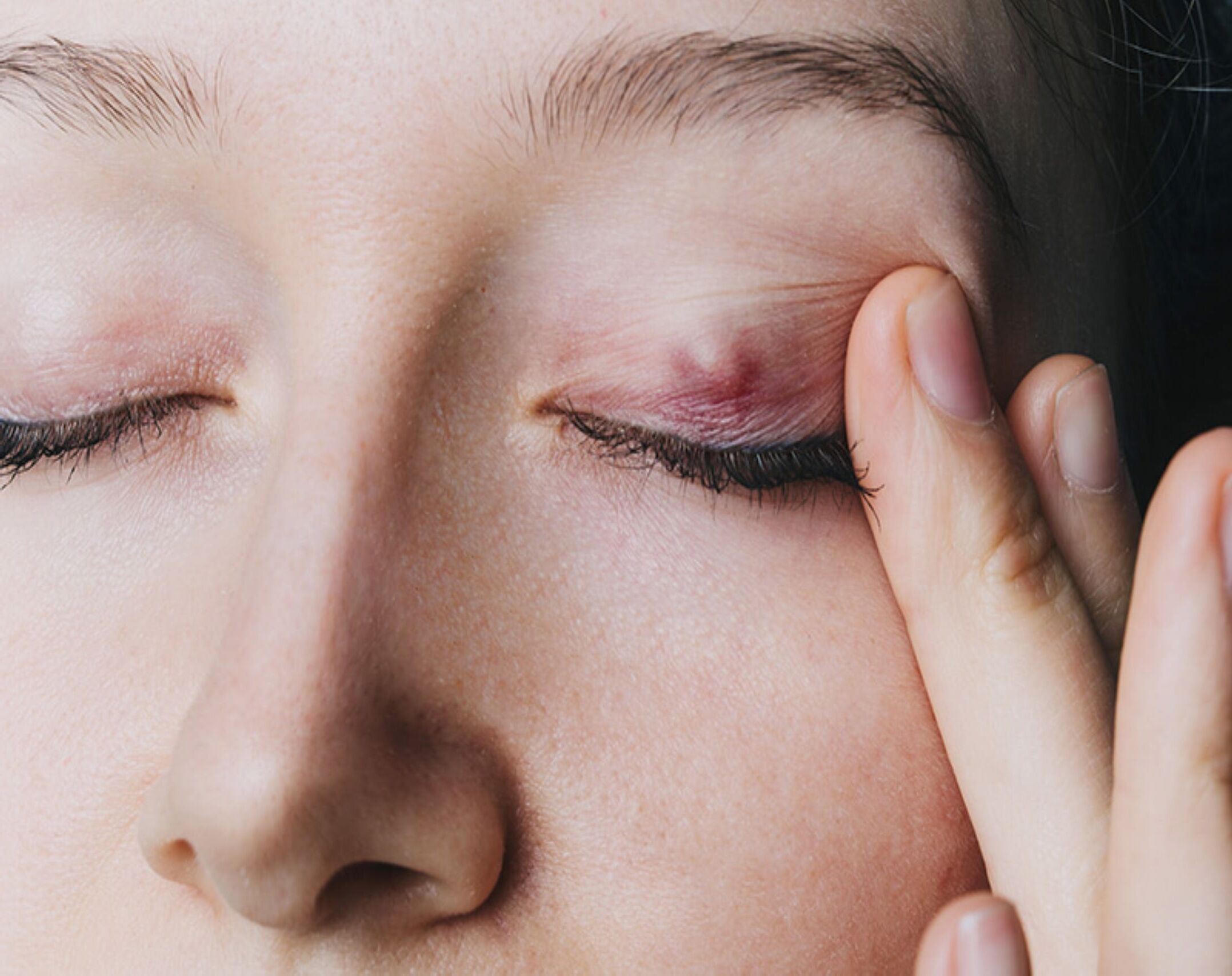 50-facts-about-chalazion