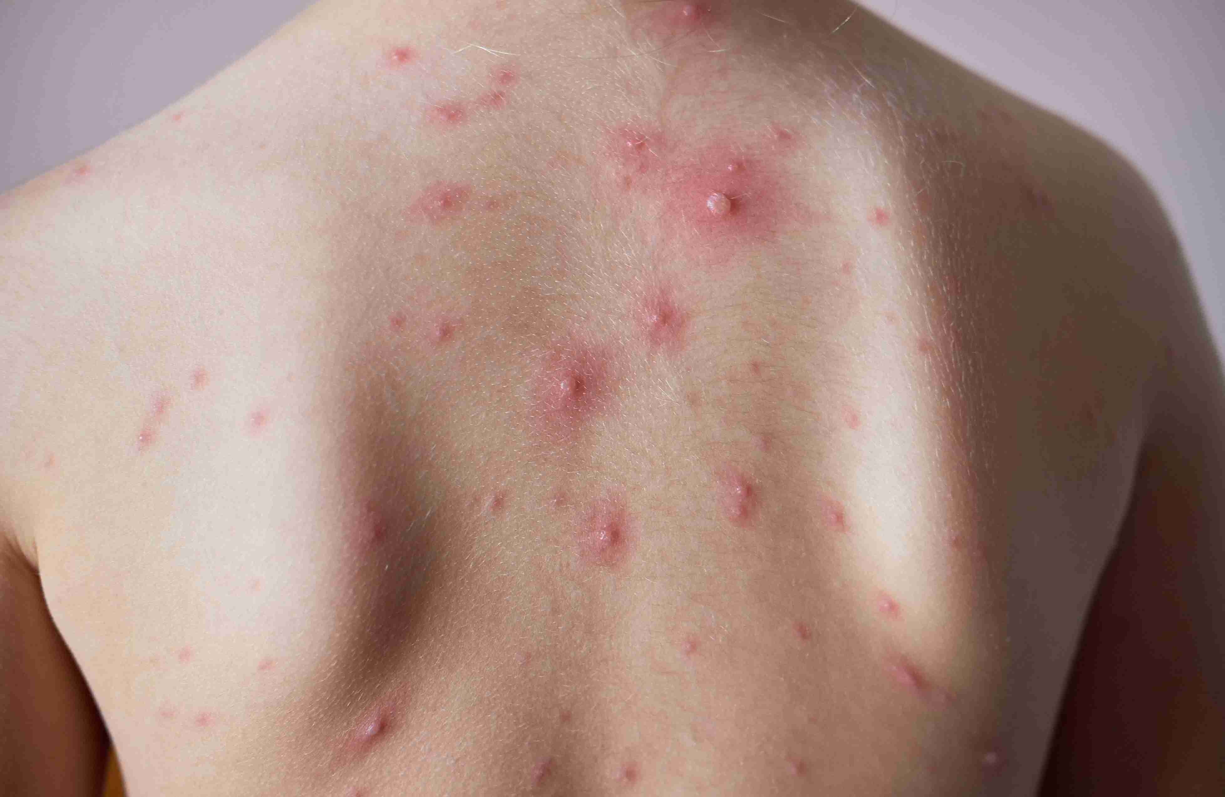 50-facts-about-chickenpox