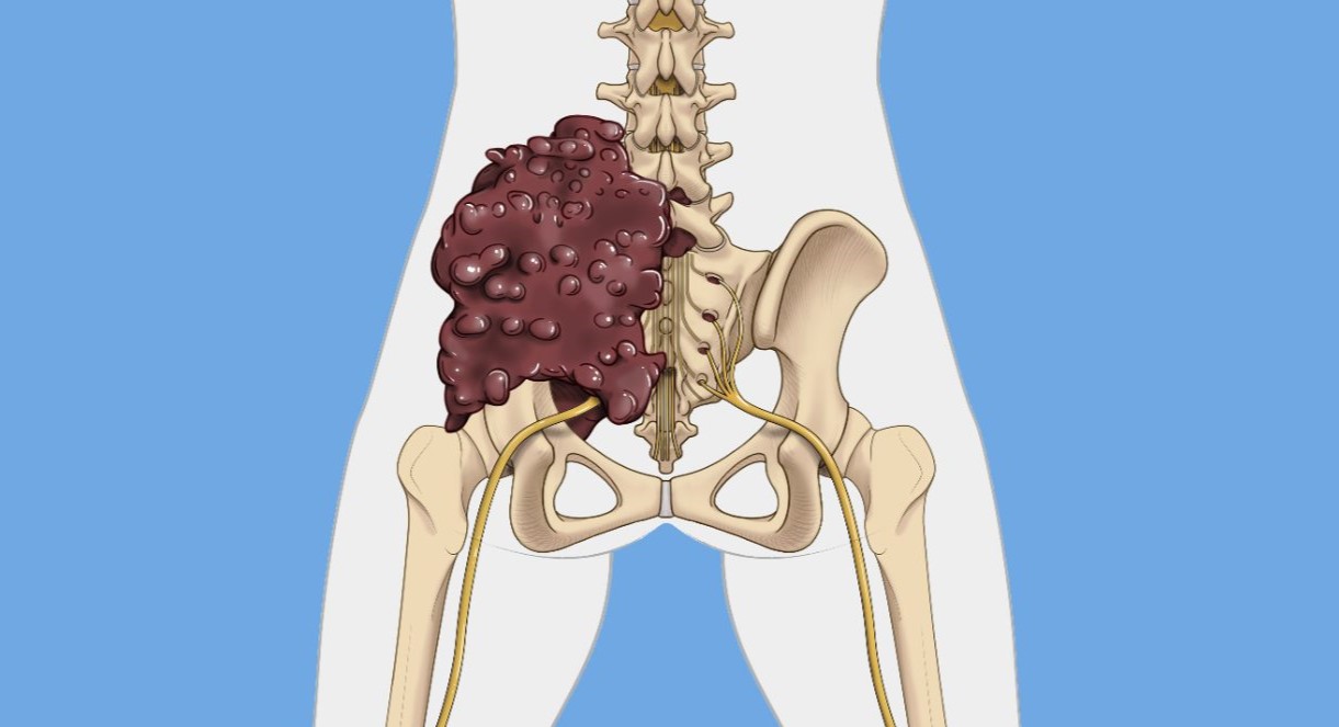 50-facts-about-chondrosarcoma