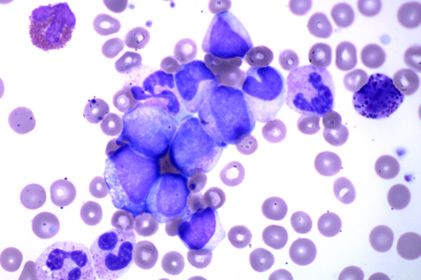 50-facts-about-chronic-myelogenous-leukemia