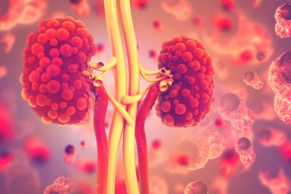 50-facts-about-chronic-renal-failure