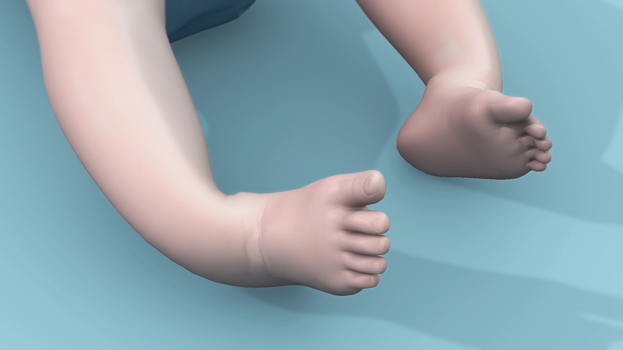 50-facts-about-clubfoot