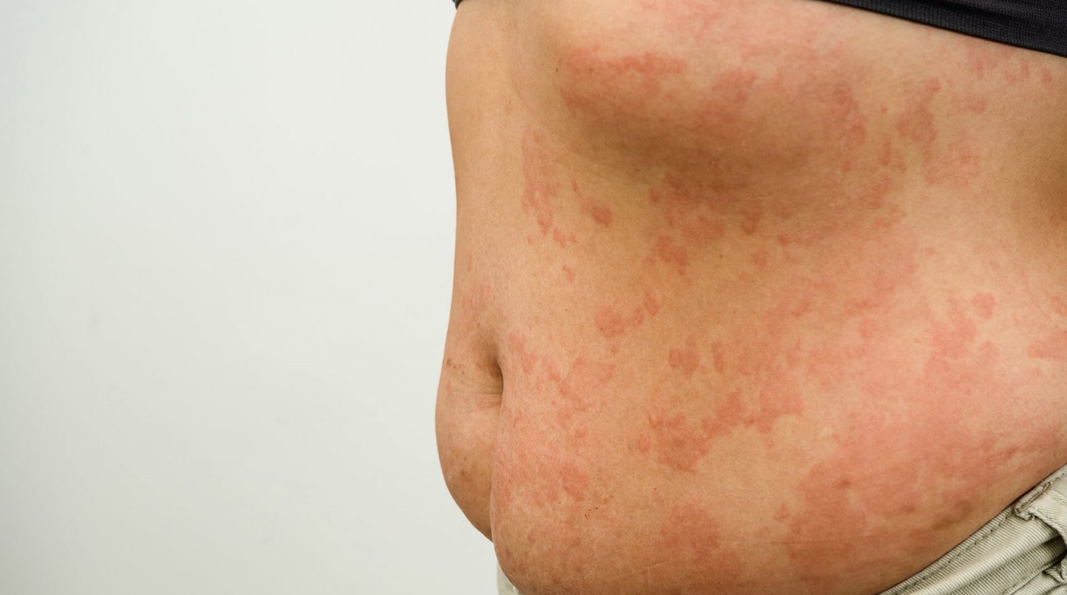 50-facts-about-cold-urticaria