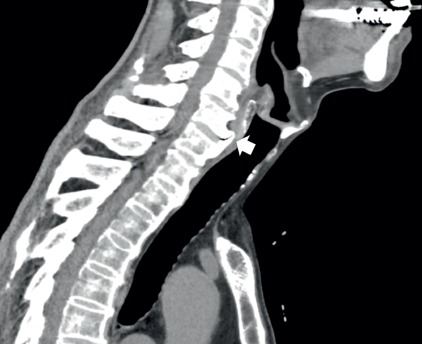 50-facts-about-diffuse-idiopathic-skeletal-hyperostosis